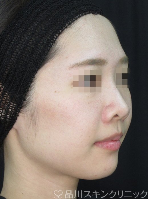 症例NO.72243のAFTER写真