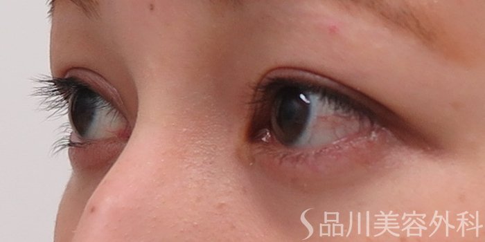 症例NO.70012のAFTER写真