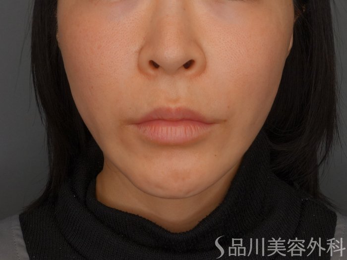 症例NO.74224のAFTER写真