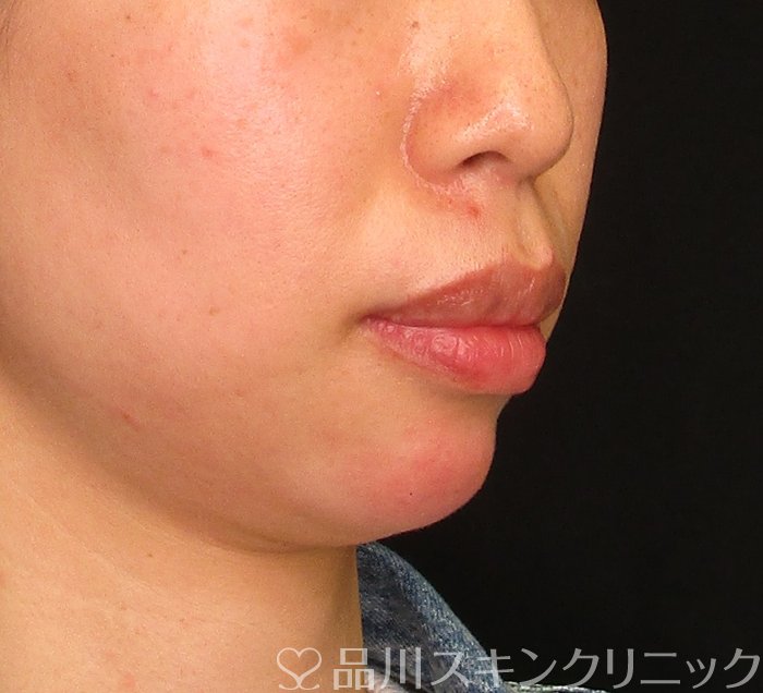 症例NO.69838のAFTER写真