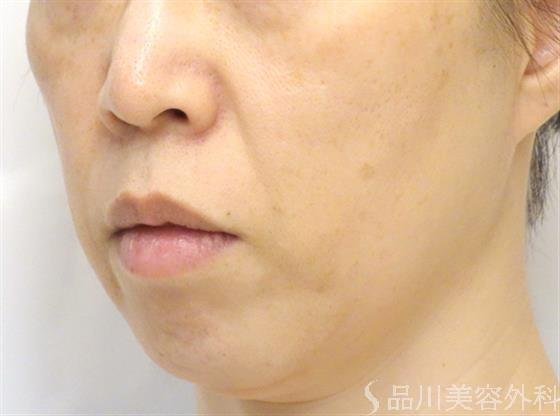症例NO.27053のBEFORE写真