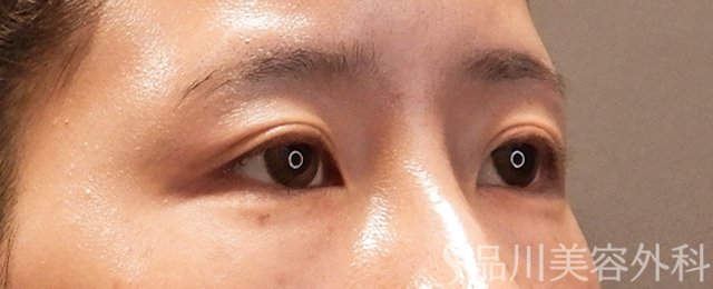 症例NO.70551のBEFORE写真