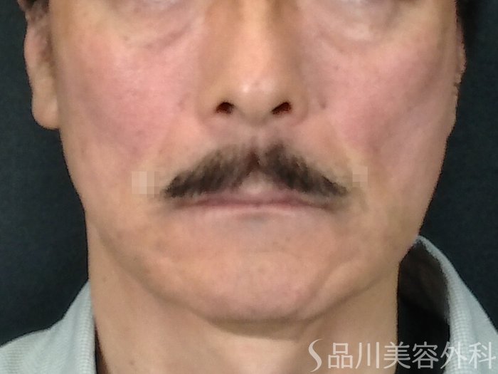 症例NO.70697のAFTER写真