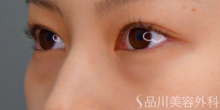 症例NO.69651のBEFORE写真