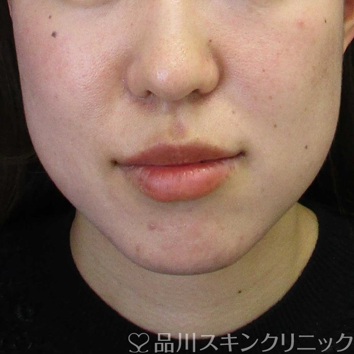 症例NO.65434のBEFORE写真