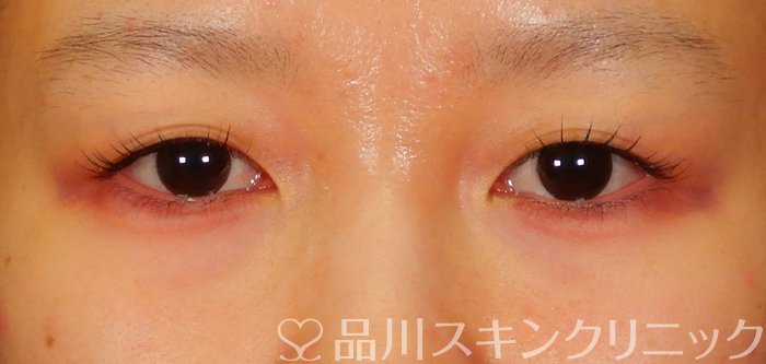 症例NO.65787のAFTER写真