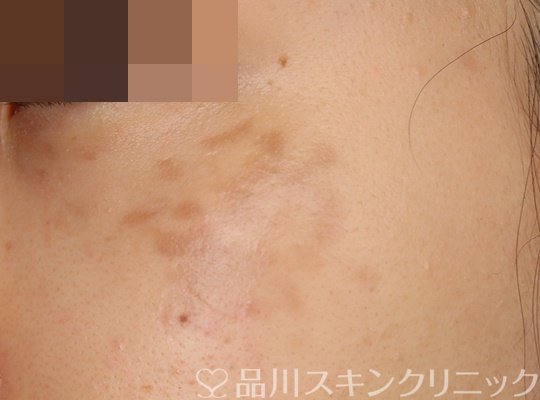 症例NO.71054のAFTER写真