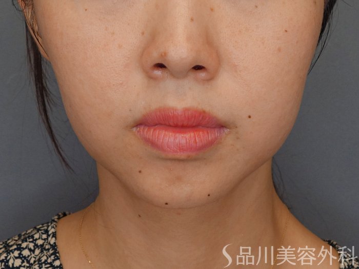 症例NO.71915のBEFORE写真