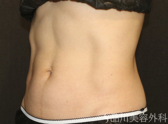 症例NO.72786のAFTER写真