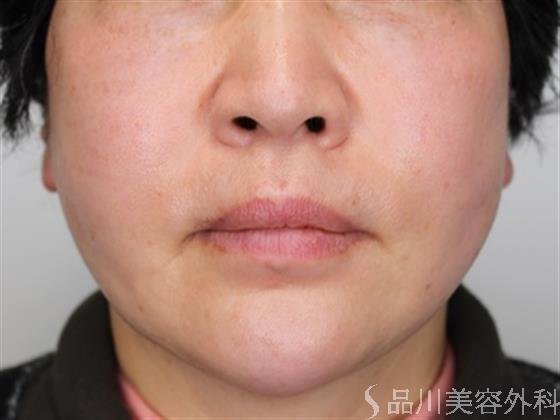 症例NO.50484のAFTER写真