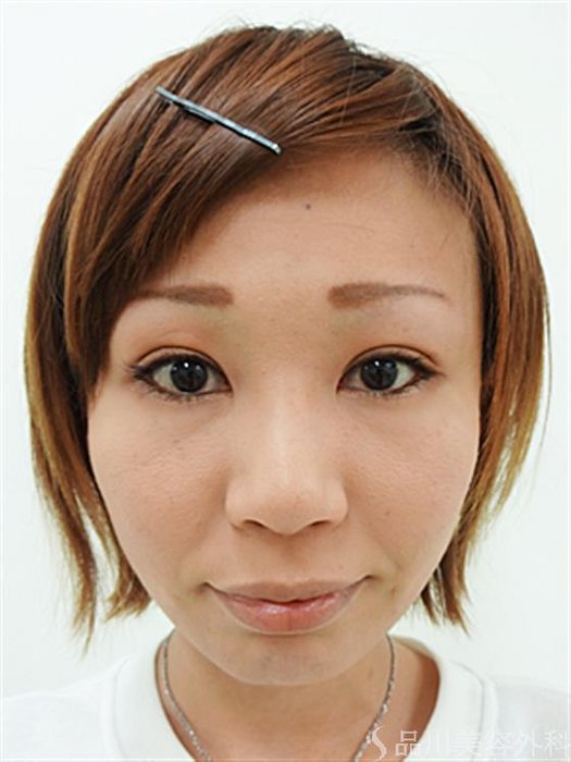 症例NO.26656のAFTER写真