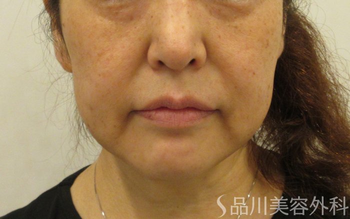 症例NO.71446のBEFORE写真