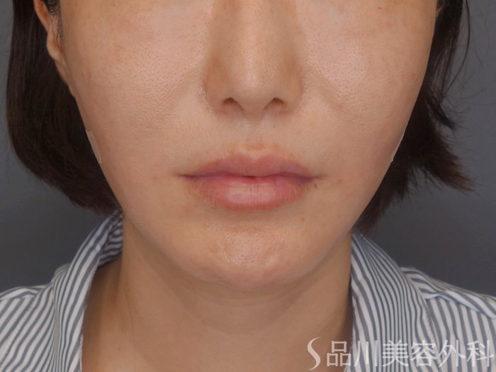 症例NO.71990のAFTER写真