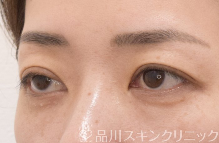 症例NO.70969のBEFORE写真