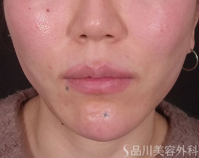 症例NO.69632のAFTER写真