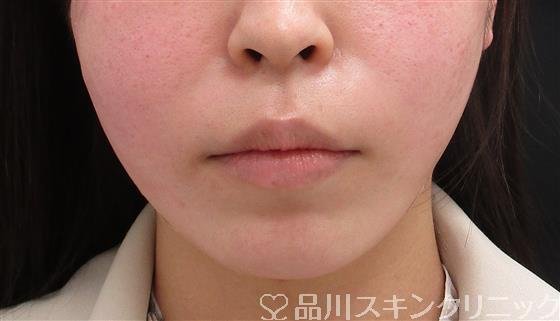 症例NO.58842のAFTER写真