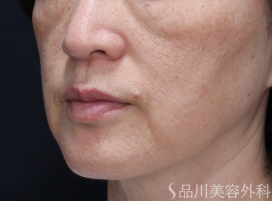 症例NO.70669のBEFORE写真