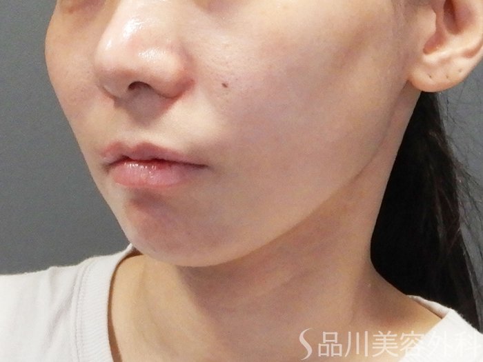 症例NO.74341のAFTER写真