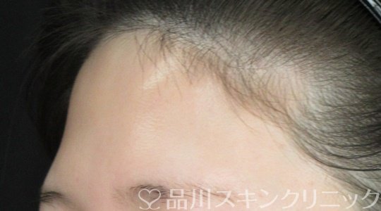 症例NO.69665のBEFORE写真