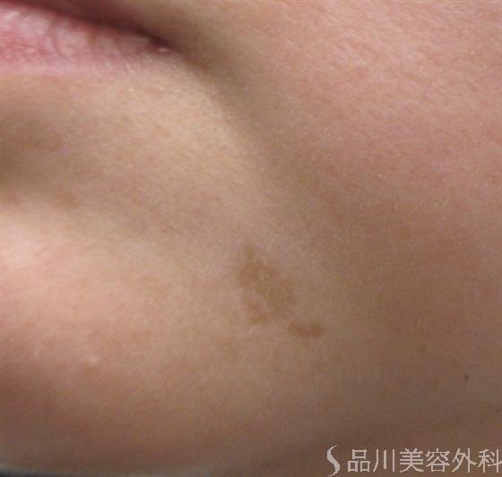 症例NO.18511のBEFORE写真