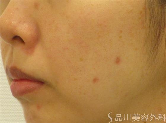 症例NO.41586のAFTER写真