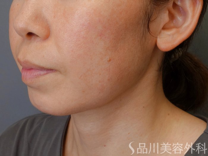 症例NO.70830のBEFORE写真