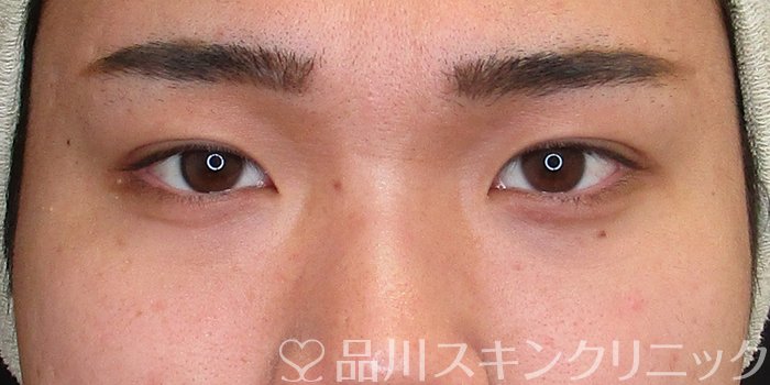 症例NO.73586のAFTER写真