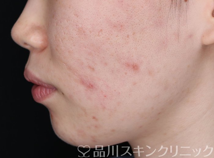 症例NO.69347のBEFORE写真