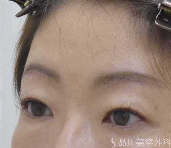 症例NO.52697のAFTER写真