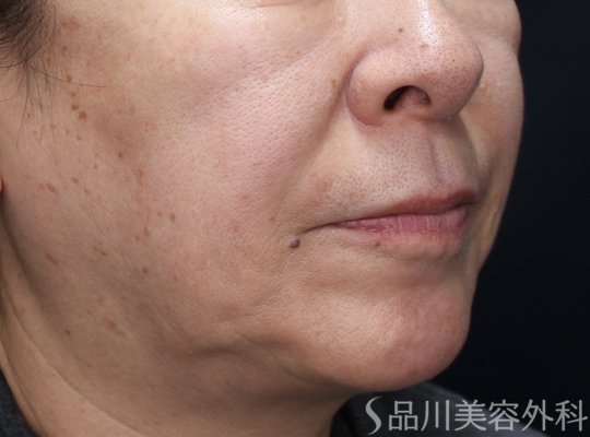 症例NO.72898のBEFORE写真