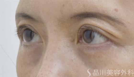 症例NO.52197のAFTER写真