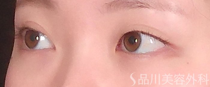 症例NO.71032のBEFORE写真