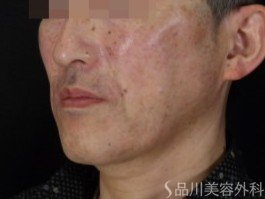 症例NO.70903のAFTER写真