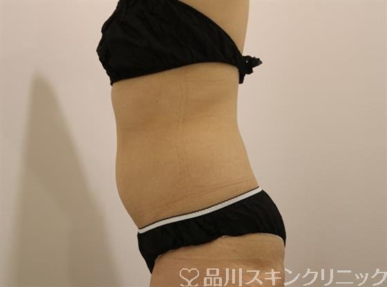 症例NO.42357のAFTER写真