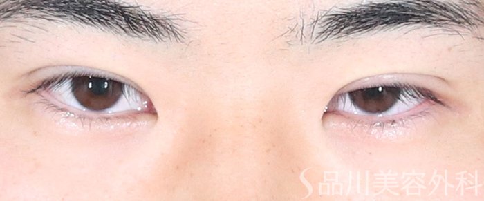 症例NO.72576のAFTER写真