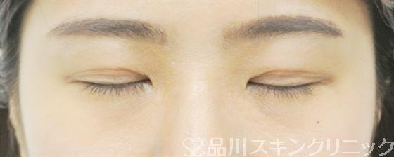 症例NO.37197のAFTER写真