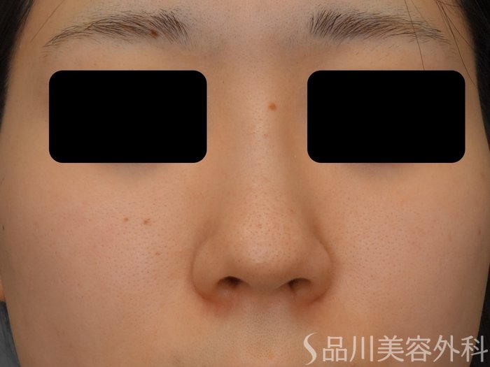 症例NO.74676のBEFORE写真
