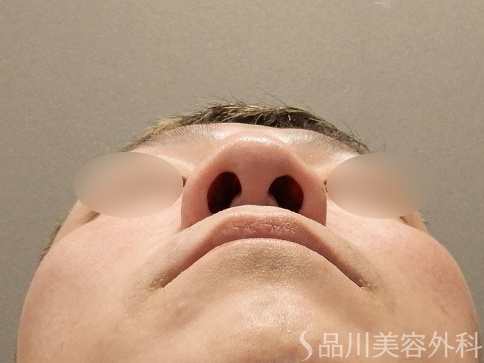症例NO.70476のBEFORE写真