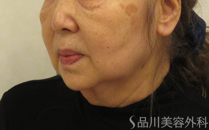 症例NO.72065のBEFORE写真