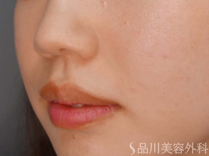 症例NO.65142のAFTER写真