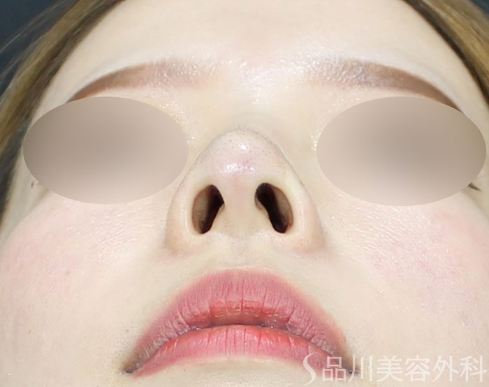 症例NO.71791のAFTER写真