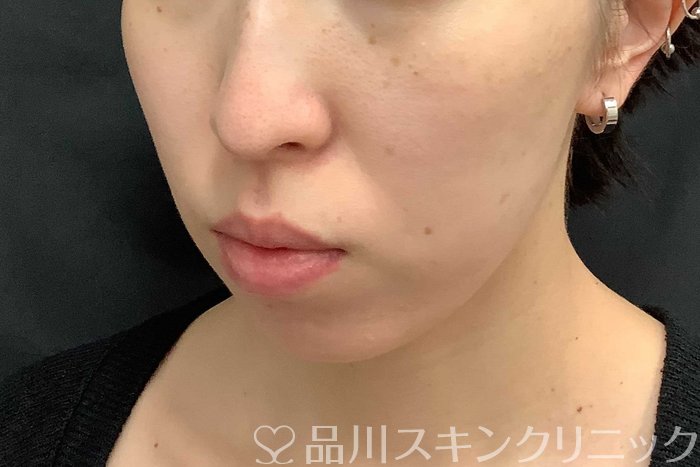 症例NO.69775のAFTER写真