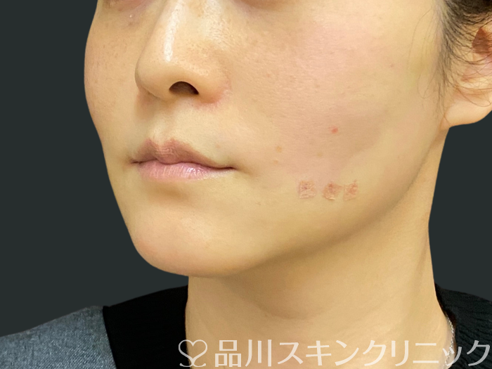 症例NO.74300のAFTER写真