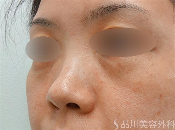 症例NO.25034のBEFORE写真