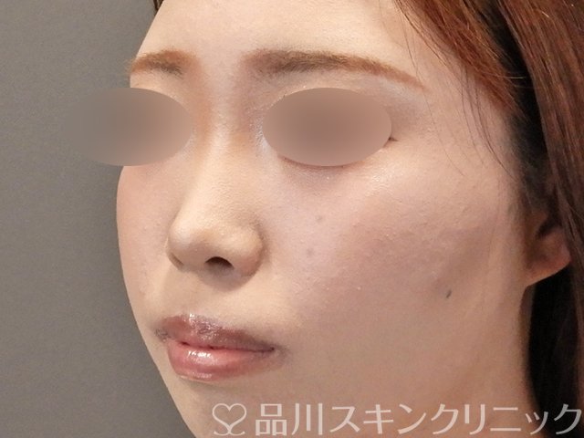 症例NO.75251のBEFORE写真