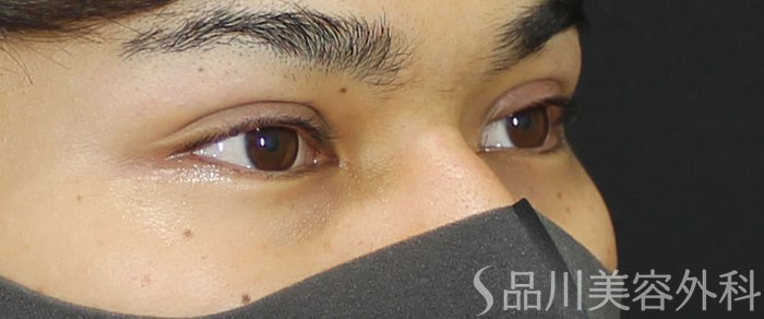 症例NO.72188のAFTER写真