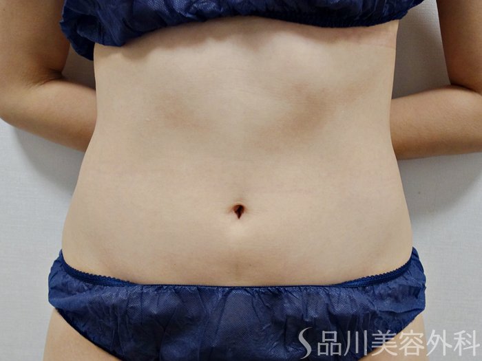 症例NO.70879のBEFORE写真