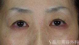 症例NO.72711のBEFORE写真