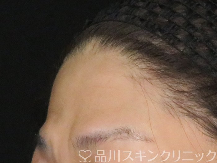 症例NO.65586のBEFORE写真