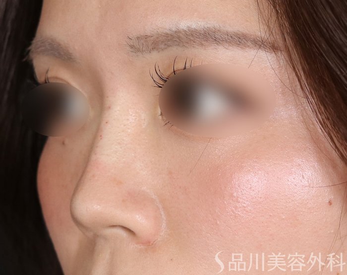 症例NO.73796のAFTER写真
